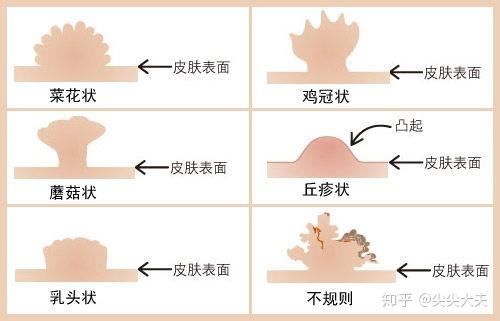 尖锐湿4个月复发的概率，探究与解析